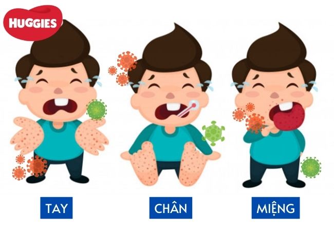 Bố mẹ cần chú ý triệu chứng tay chân miệng ở trẻ