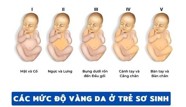 dấu hiệu vàng da ở trẻ sơ sinh