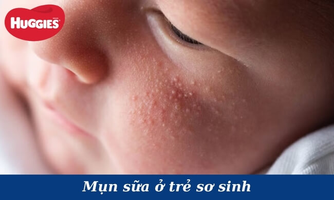 mụn sữa ở trẻ sơ sinh