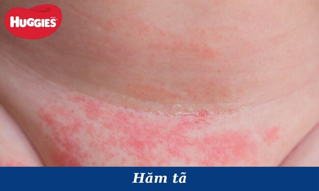hăm tã ở trẻ sơ sinh