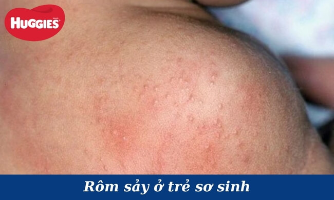 rôm sảy ở trẻ sơ sinh