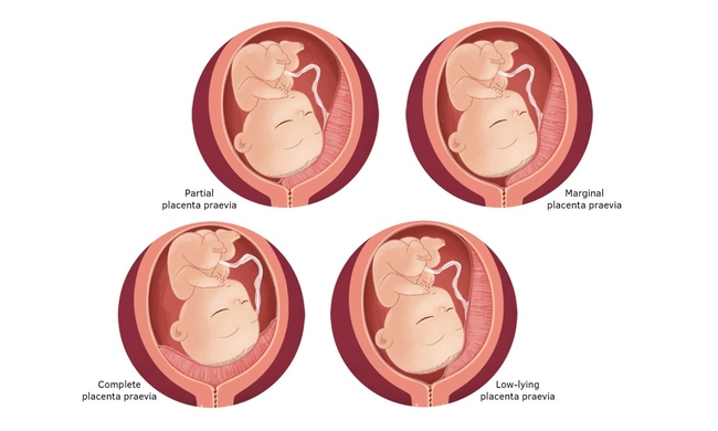 Các trường hợp nhau thai bám thấp