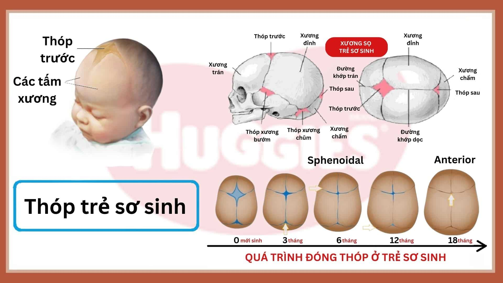 Quá trình đóng thóp ở trẻ sơ sinh