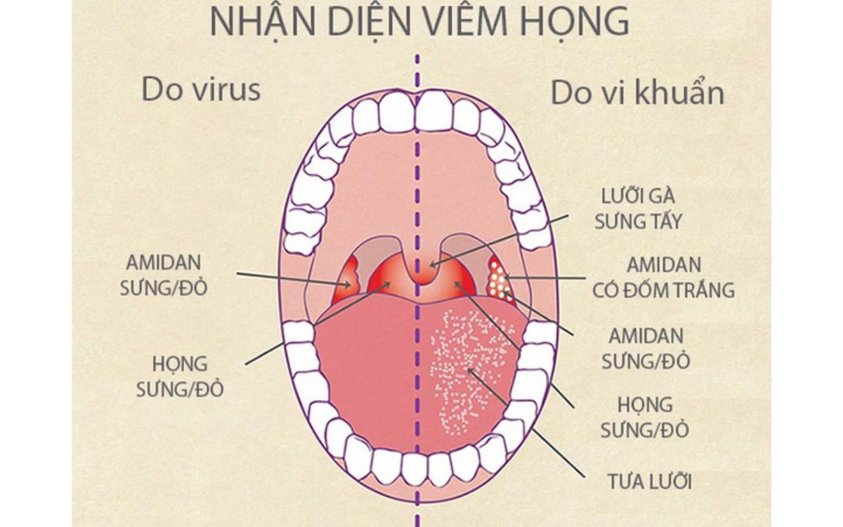 Một số triệu chứng thường gặp khi trẻ bị viêm họng