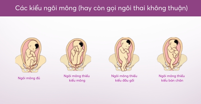 Dự đoán ngôi thai bằng tay