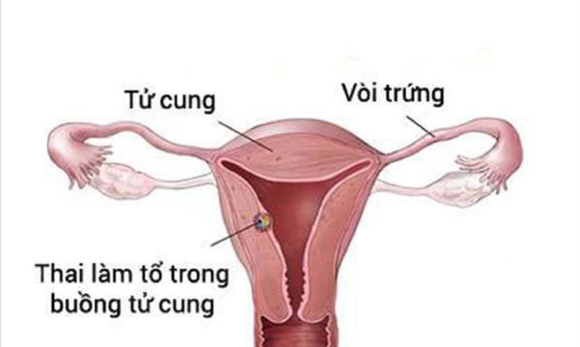 Dấu hiệu thai vào tử cung Dấu hiệu thai vào tử cung