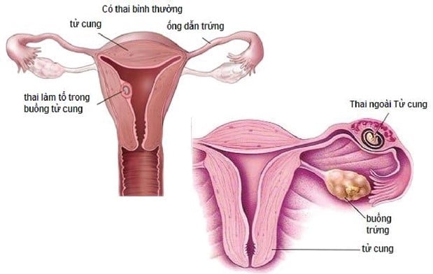 Thai chưa vào tử cung - Thai ngoài tử cung Thai chưa vào tử cung - Thai ngoài tử cung